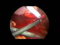 Complication During Laparoscopic Surgery