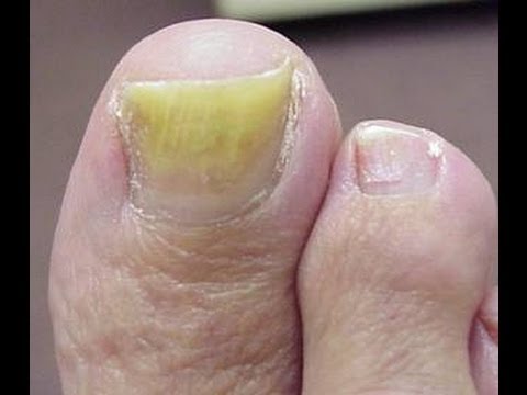 how to get rid of nail fungus quickly