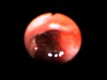 Bronchoscopic Video Clips - Dr. P.N. Agrawal , Bhopal