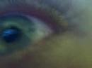 My pinkeye