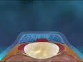IntraLase Flap Procedure - The bladeless Cornea Flap prep