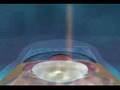 IntraLase Flap Procedure - The bladeless Cornea Flap prep
