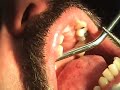 blue-sky-bio-implants-ridge-split.html