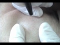 Blackhead treatment