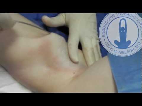 how to treat axillary hyperhidrosis