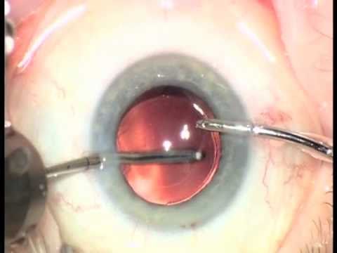 Operation des Grauen Stars im Augen Chirurgie Zentrum Baunatal