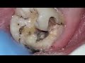 Monster cavity under