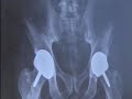 Hip Resurfacing- Fox News.m4v Hip Resurfacing- Fox News.m4v