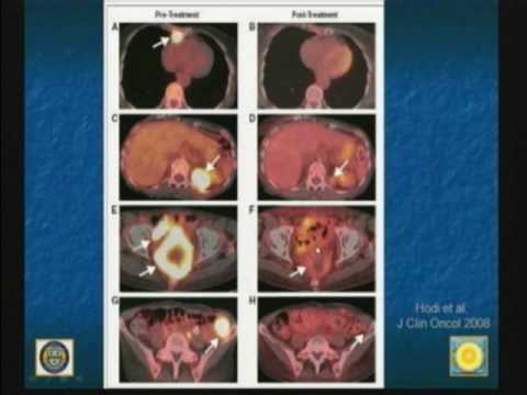 New Options in Melanoma Therapy Dr John Kirkwood Feb 2010