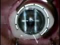 LASIK