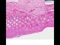 Histopathology Colon --Pseudomembranous colitis