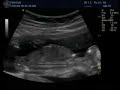 Ultrason Evellyn 16 Semanas Ultrason Evellyn 16 Semanas