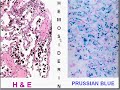 Medical School Pathology, Chapter 8j