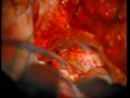 My Brain Surgery - Part 08 of 14