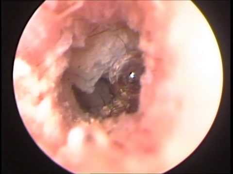 how to drain otitis externa