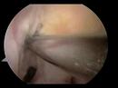 ACL Reconstruction ACL Reconstruction