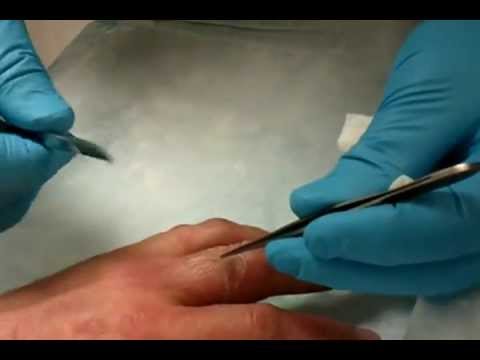 how to treat open burn blisters