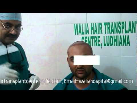 how to sleep after fue hair transplant