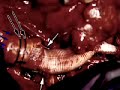 Aortda anostomoz y�ntemleri