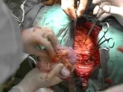 how to do a lung transplant
