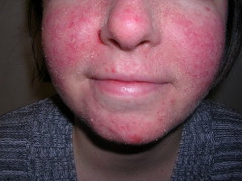 how to relieve eczema on face