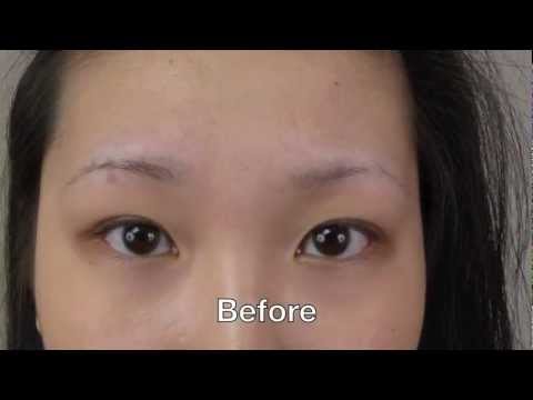 how to transplant eyebrows