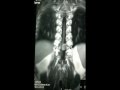 spina cord tumor-meningioma-microsurgery-dr suresh dugani/HUBLI/KARNATAK/INDIA
