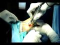 Bunion Removal Surgery