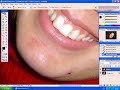 Video aula tutorial - Fim das espinhas das fotos(photoshop) Video aula tutorial - Fim das espinhas das fotos(photoshop)