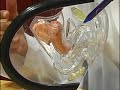 Vaginal Rejuvenation by Laser