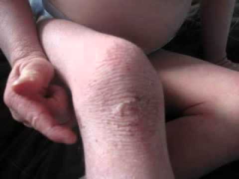 how to use tea tree oil for eczema