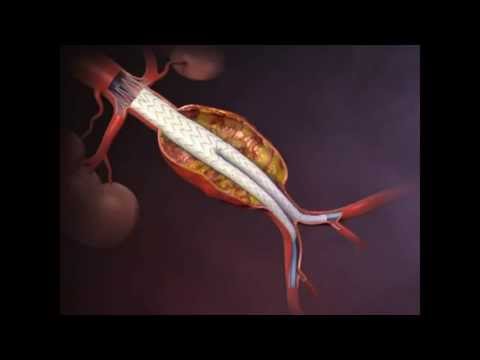 how to cure aortic aneurysm