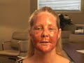 fat-grafting-dallas-rhytec-portrait-plasma-recovery-dallas.html