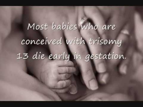 trisomy 13