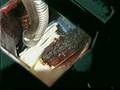 TRANSMEDIASTINAL OPEN SURGERY FOR BILATERAL PNEUMOTHORAX