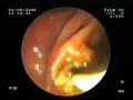 Klatskin (Koledok Üst Uç) Tümörü Metal Stent Yerle?tirme Klatskin (Koledok Üst Uç) Tümörü Metal Stent Yerle?tirme