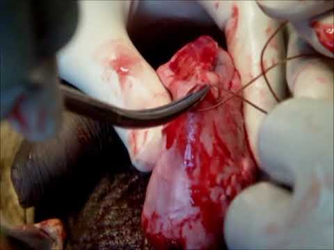 how to drain hydrocele