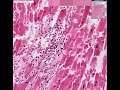Histopathology Heart--Toxoplasma gondii myocarditis