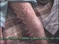 videos de acupunture--02-----------