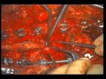Lumbar Pedicle Subtraction Osteotomy