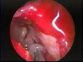 Resection of a Large Concha Bullosa Hawke MD