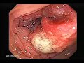 video-colonoscopy-displaying-a-colon-cancer.html