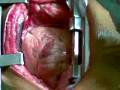 Awake CABG.mp4