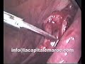 laparoscopic conservativ treatment of ectopic pregnancy