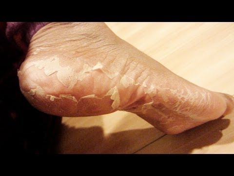 Baby foot - GET BABYFOOT HERE!!! http://colouredbeautiful.com/my-foot-transformation-eliminate-crusty-feet/