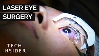 What It’s Like To Get Laser Eye Surgery