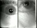 myasthenia