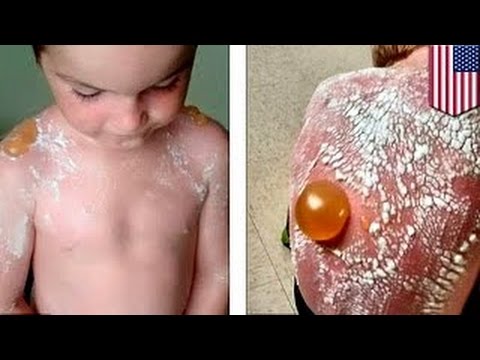 Ожоги на детской коже Ожоги на детской коже