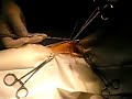 castration d\