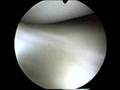 Meniskus OP - Meniscus Surgery